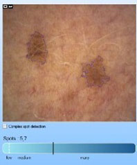 mark pigmented spots