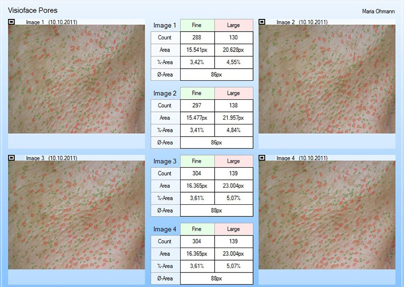 VisioFace® analysis of fine and large pores